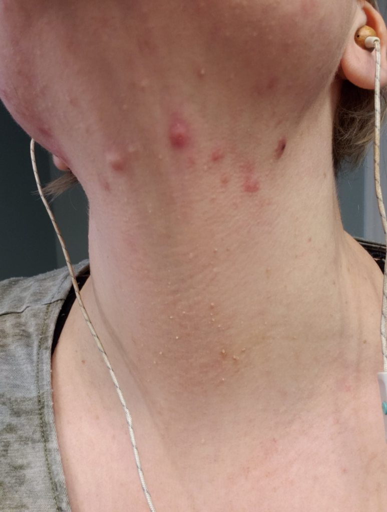 My experience with acne / accutane | Cambria Hebert